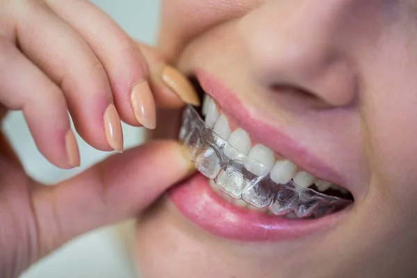 Braces and Aligners
