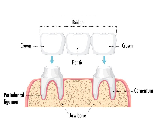 Crowns and Bridges